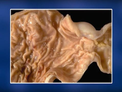 0320 Alcohol The Medical Consequences...