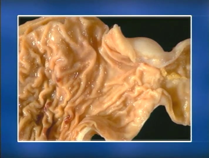 0323A Alcohol The Medical Consequences Pt1 SP