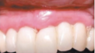 Lasers in Contemporary Implant Dentistry - Part 2
