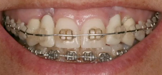 Esthetic Implant Failures - Etiologies and Solutions