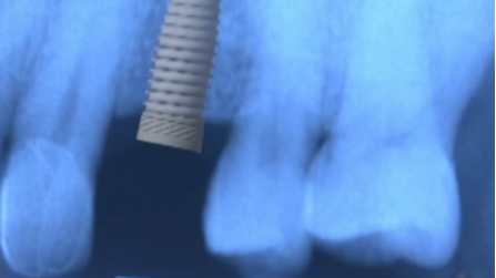 CLINICAL VIDEO Single Implant Placement for Missing Upper Premolar: Surgical 