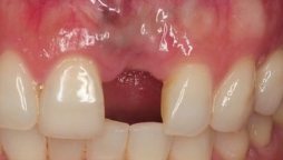 CLINICAL VIDEO Staged Horizontal GBR and Soft Tissue Augmentation for Anterior S