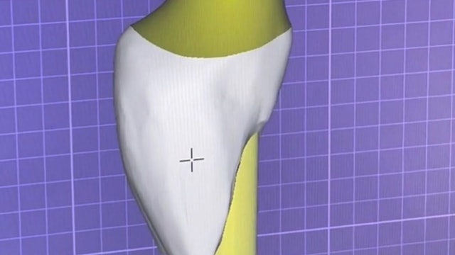 CLINICAL VIDEO Immediate 3D Designed and Printed Implant Temporization at  