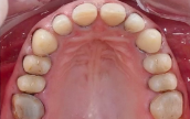 Modern Approach to Tooth Preparation: Full Enamel Concept