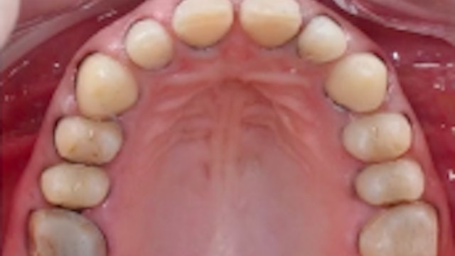 Modern Approach to Tooth Preparation: Full Enamel Concept