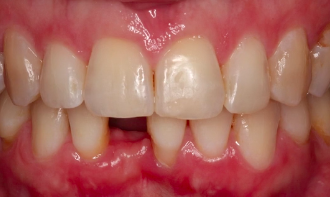 CLINICAL VIDEO Staged Horizontal Ridge Augmentation using GBR in a Severely Res