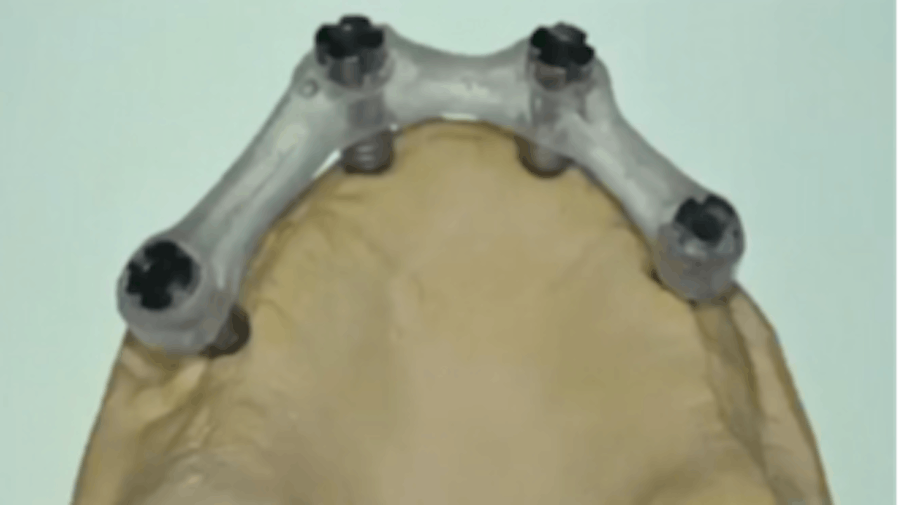 AZ in Restorative Implant Dentistry (Case 4) Maxillary Allon4