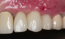 CLINICAL VIDEO Free Gingival Harvest and Uncovering of Two Anterior Implants wit