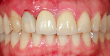 Anterior Immediate Implant Placement and Function - The Digital Workflow