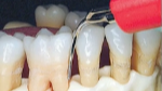 A-Z of Dental Hygiene Part 10 - Non-Surgical Periodontal Therapy 02