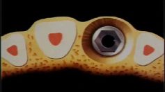 Immediate Placement in Fresh Extraction Socket: State of the Art