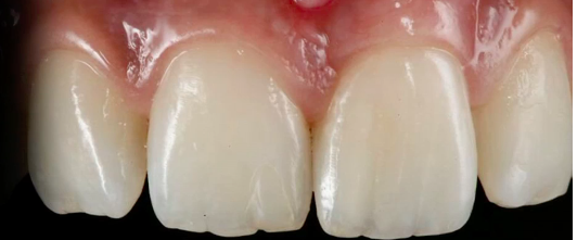 Advances in Post Extraction Tooth Implant Cases in the Esthetic Zone |Dr E. Euwe