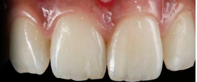 Advances in Post Extraction Tooth Imp...