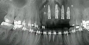 Benefits of the TR-Membrane in Vertical Ridge Augmentation