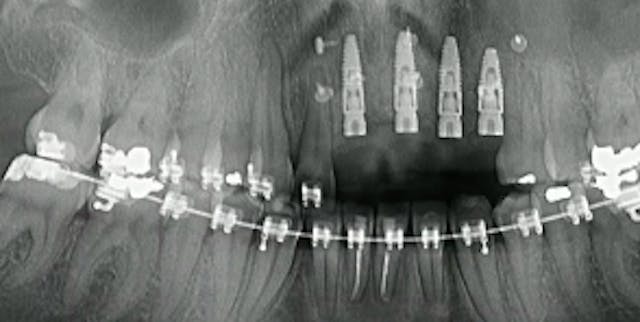 Benefits of the TR-Membrane in Vertic...