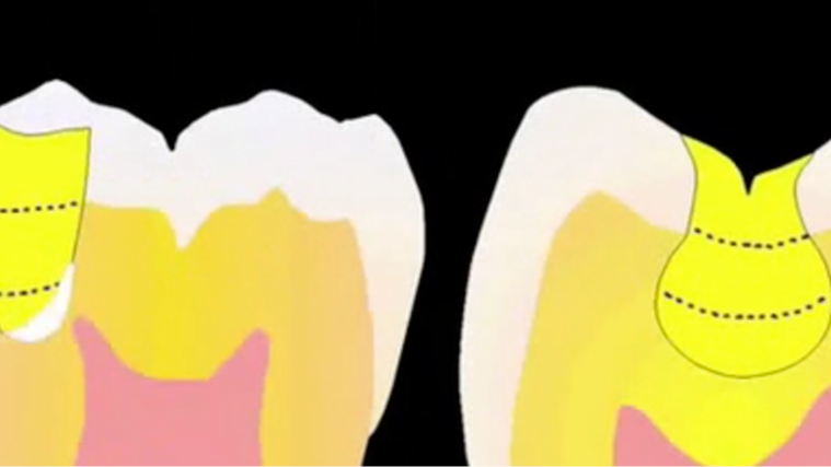 Posterior Composites Restorations (Direct and Semidirect Techniques)