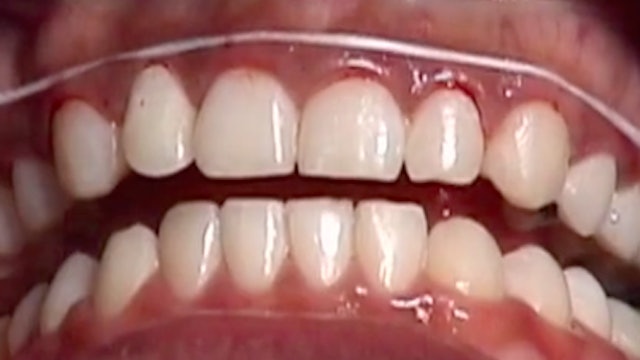 CLINICAL VIDEO Periodontal Surgery for Esthetic Crown Lengthening