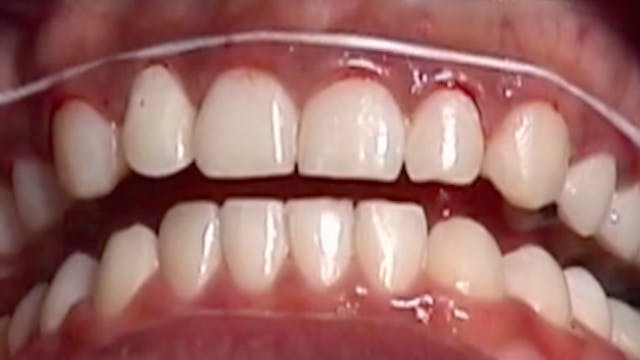 CLINICAL VIDEO Periodontal Surgery fo...