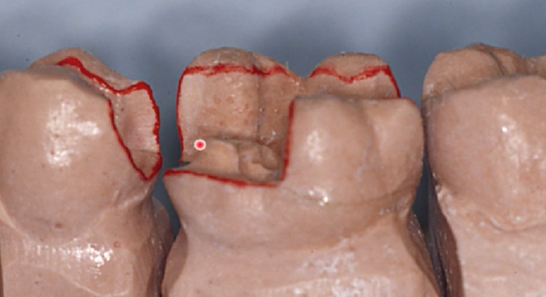 Direct to Indirect Restorations
