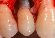 Periimplantitis: Etiology, Risk Factors, Treatment Options, Prevention