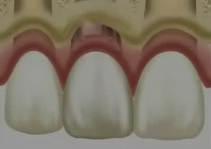 Immediate tooth replacement and surgical challenges