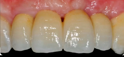 Esthetics in a Diseased Periodontium - Tips & Tricks