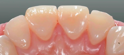 Worn Dentition? Direct (Index Technique) and Indirect (Composite/Ceramic Onlays