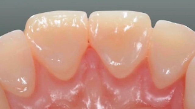 Worn Dentition? Direct (Index Technique) and Indirect (Composite/Ceramic Onlays