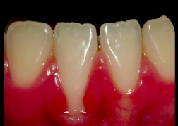 Severe Gingival Recession Treatment with Connective Tissue Grafts