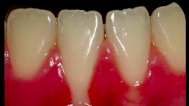 Severe Gingival Recession Treatment w...