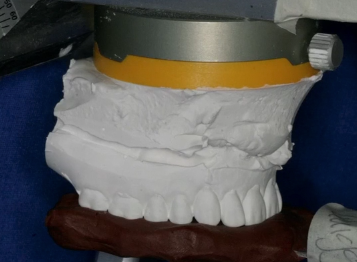 Treating the Edentulous Arch with Removable Implant Overdentures - Procera CAD/