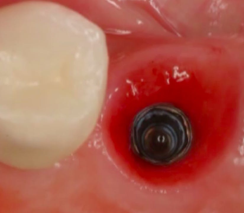 CLINICAL VIDEO Immediate SingleImplant Placement and Loading After