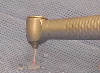 CLINICAL VIDEO Sinus Lift using lateral window approach with placement of 2 impl