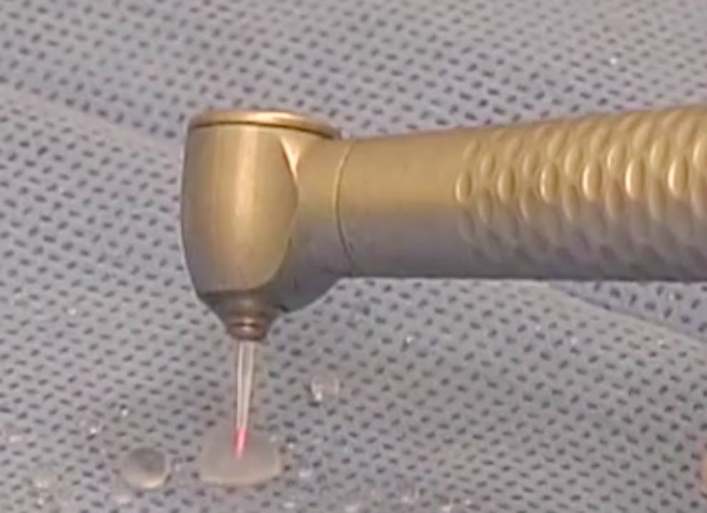 CLINICAL VIDEO Sinus Lift using lateral window approach with placement