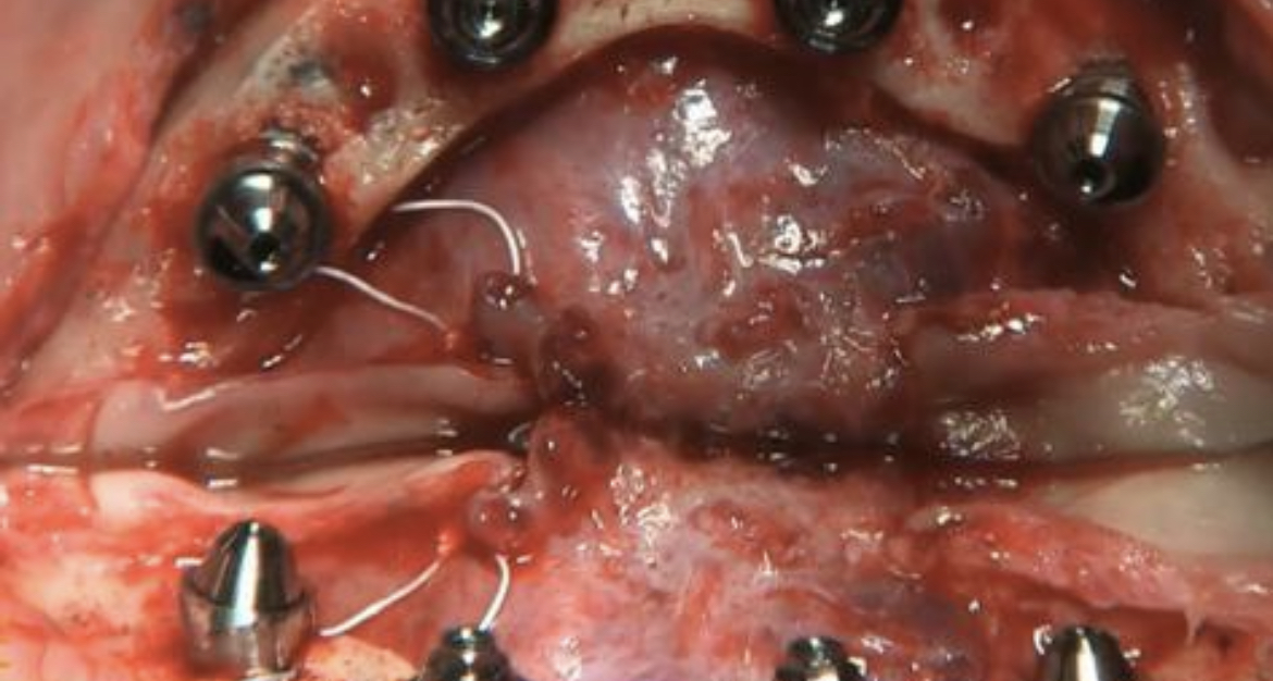 CLINICAL VIDEO All-on-4 For Edentulous Lower Jaw with Failing Dentition