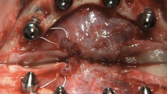 CLINICAL VIDEO - All-on-4 For Edentulous Lower Jaw with Failing Dentition