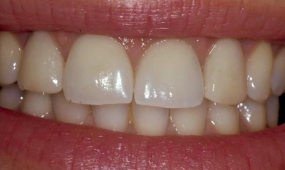 Restoration of 'Failing Teeth' with Implants in the Aesthetic Zone - Surgical a
