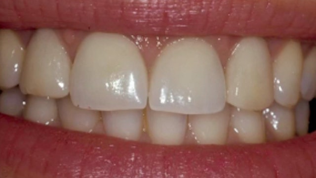 Restoration of 'Failing Teeth' with Implants in the Aesthetic Zone - Surgical a