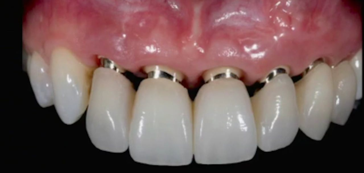 Immediate Implant Placement in the Esthetic Zone gIDE Dental Institute