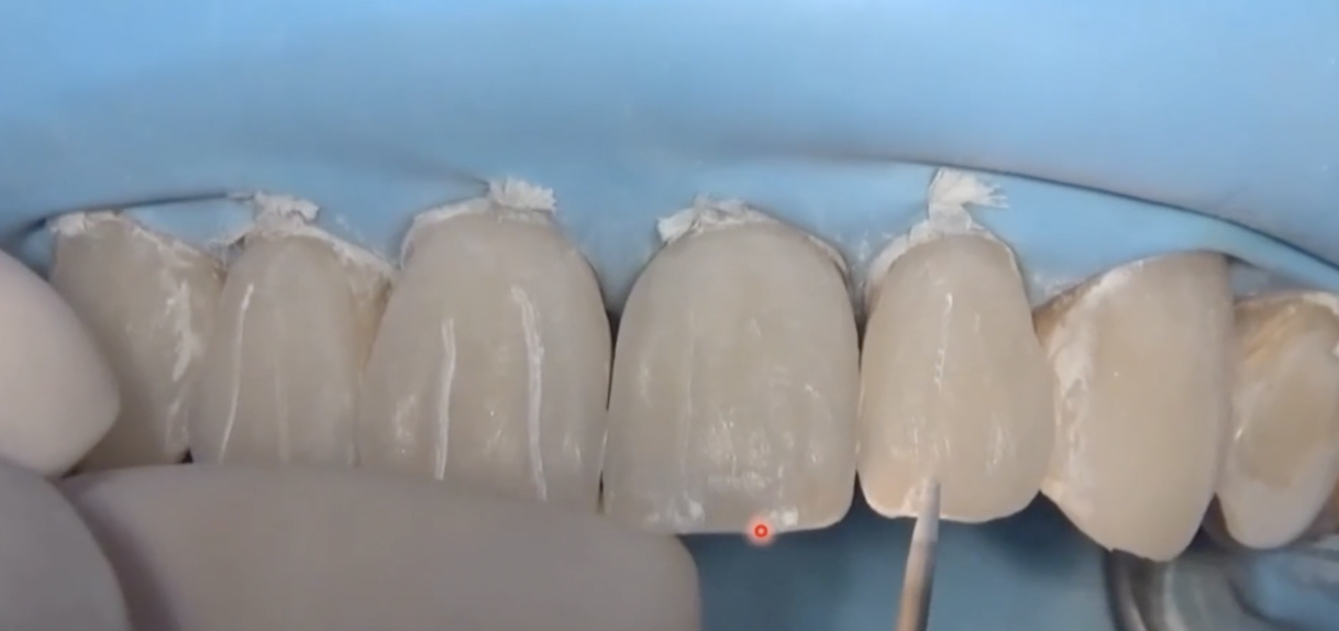 CLINICAL VIDEO Finishing and polishing steps for anterior composite esthetics