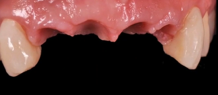  Transferring the Ideal Soft Tissue Architecture to the Lab | Dr Giacomo Fabbri