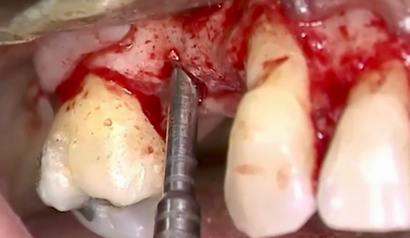 CLINICAL VIDEO Closed sinus lift, implant placement, GBR, and root coverage ther