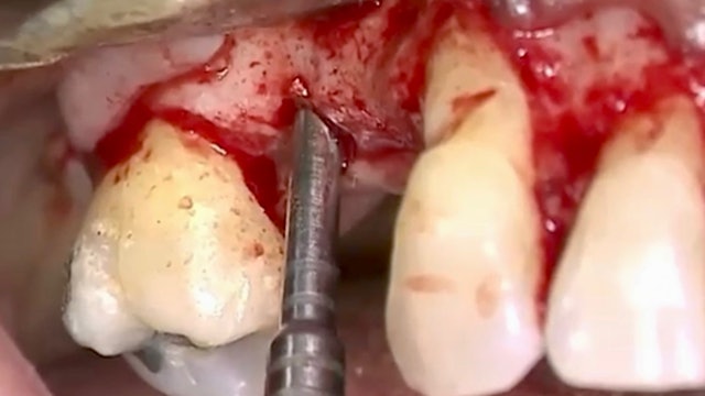 CLINICAL VIDEO Closed sinus lift, implant placement, GBR, and root coverage ther