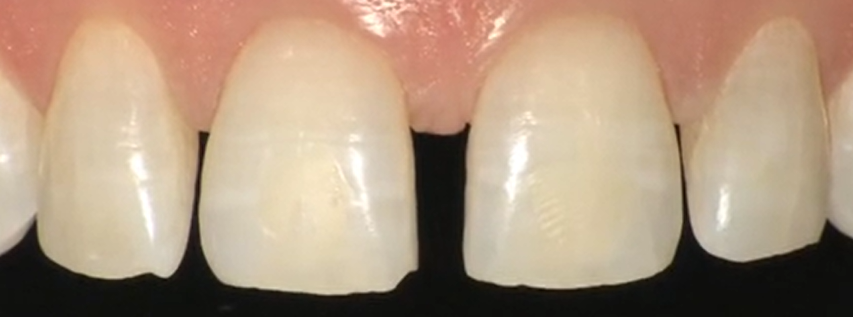 CLINICAL VIDEO Previsualization in Esthetic Dentistry| Dr Francesco Minrone