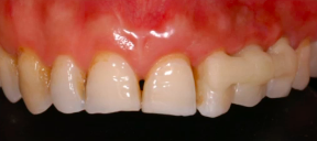 Restorative Excellence–Occlusion on Implant Retained Restorations|Dr Stefan Paul