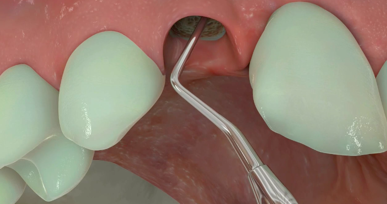 Early Implant Placement Post Extraction with Simultaneous Contour Augmentation