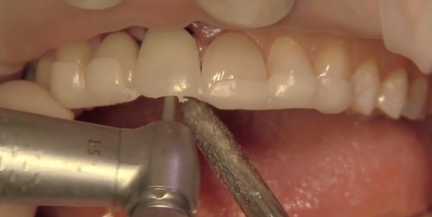 LIVE EVENT Immediate Tooth Replacement Q&A | Dr Sascha A Jovanovic