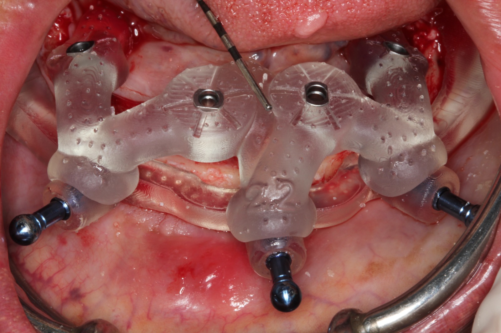 CLINICAL VIDEO Stackable Guides for a Full Arch BLX Implant Case with an Immedia