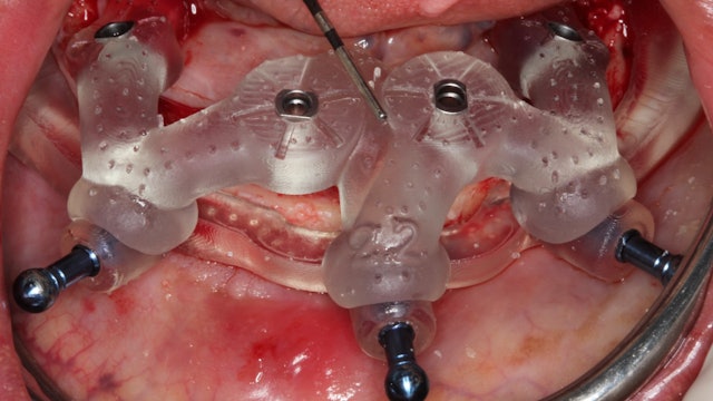 CLINICAL VIDEO Stackable Guides for a Full Arch BLX Implant Case with an Immedia