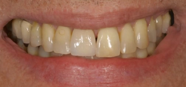 Aspectos Biologicos em Implantes Unitarios (PORTUGUESE LANGUAGE ONLY)